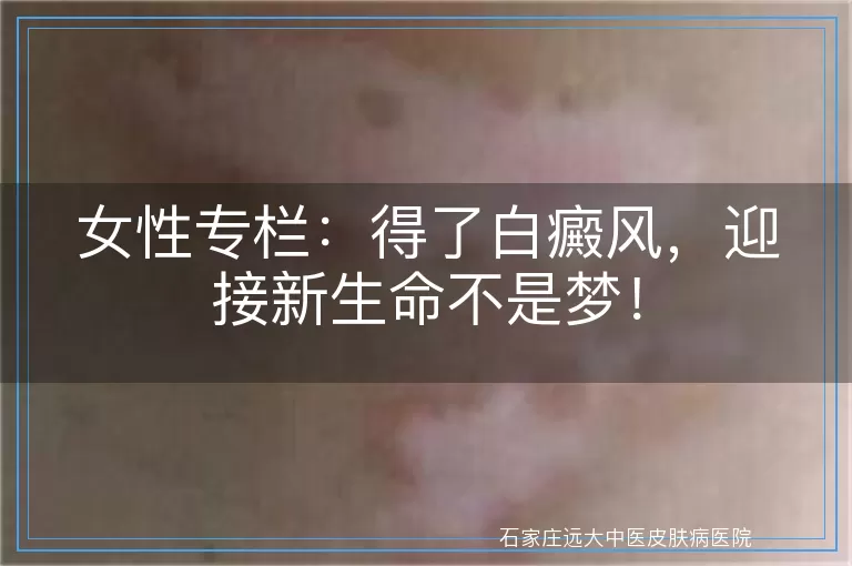 女性专栏：得了白癜风，迎接新生命不是梦！