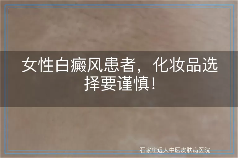 女性白癜风患者,化妆品选择要谨慎!