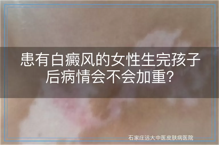 患有白癜风的女性生完孩子后病情会不会加重？