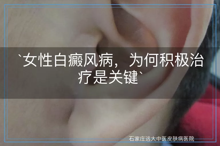 女性白癜风病，为何积极治疗是关键