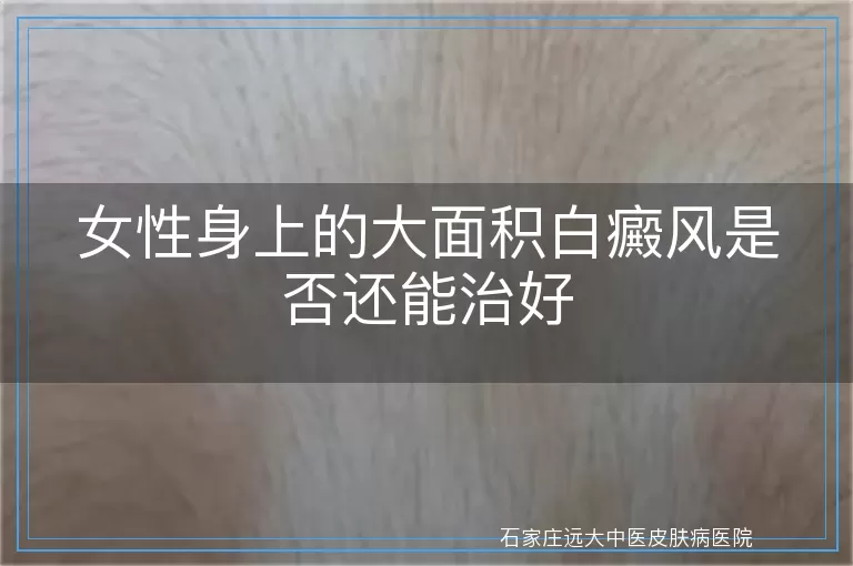 女性身上的大面积白癜风是否还能治好