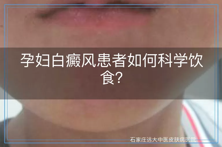 孕妇白癜风患者如何科学饮食?