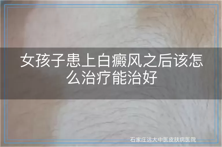 女孩子患上白癜风之后该怎么治疗能治好
