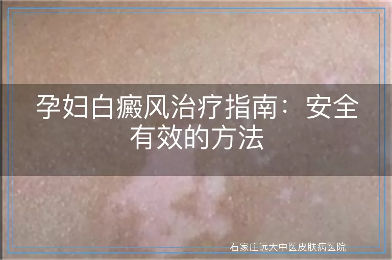 孕妇白癜风治疗指南：安全有效的方法
