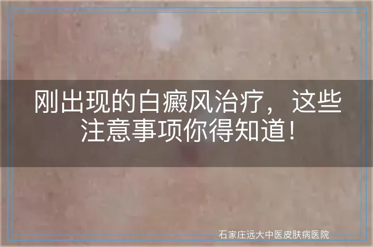 刚出现的白癜风治疗，这些注意事项你得知道！