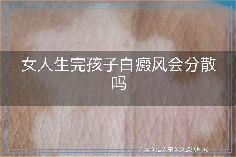 女人生完孩子白癜风会分散吗