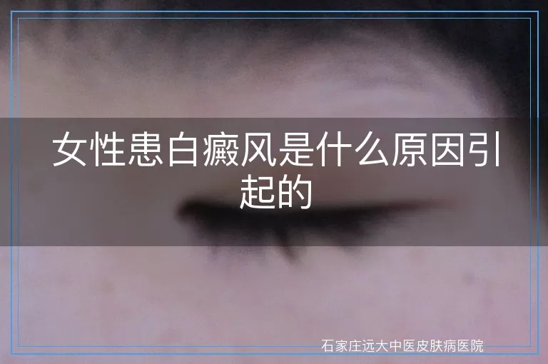 女性患白癜风是什么原因引起的