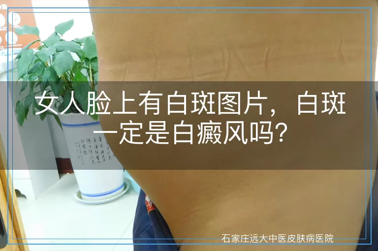 女人脸上有白斑图片，白斑一定是白癜风吗？