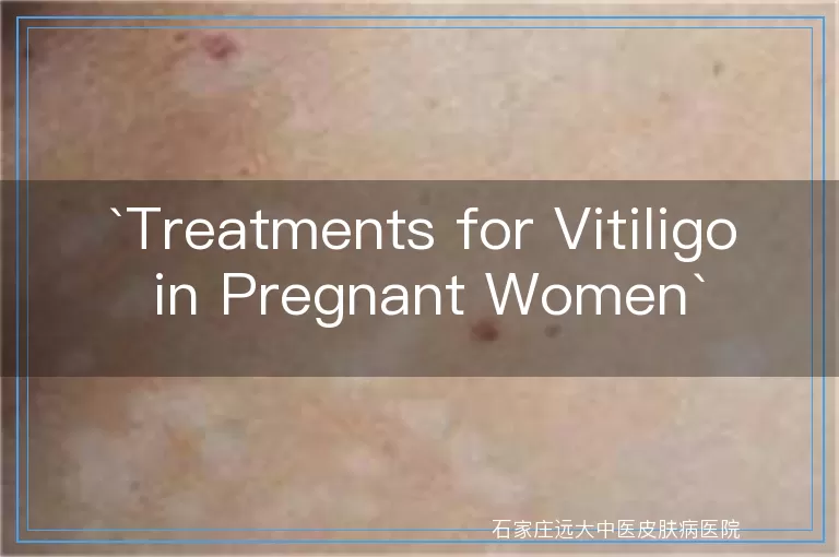 Treatments for Vitiligo in Pregnant Women
