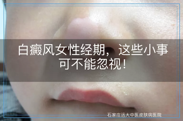 白癜风女性经期，这些小事可不能忽视！