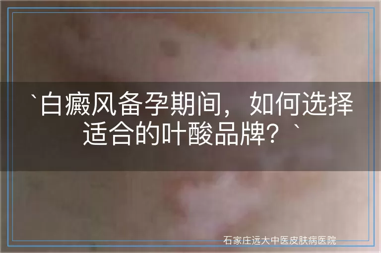 白癜风备孕期间，如何选择适合的叶酸品牌？