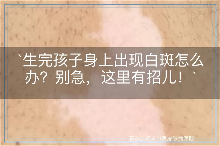生完孩子身上出现白斑怎么办？别急，这里有招儿！