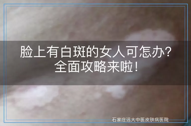 脸上有白斑的女人可怎办？全面攻略来啦！