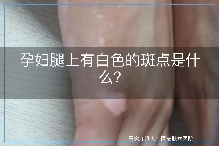 孕妇腿上有白色的斑点是什么?