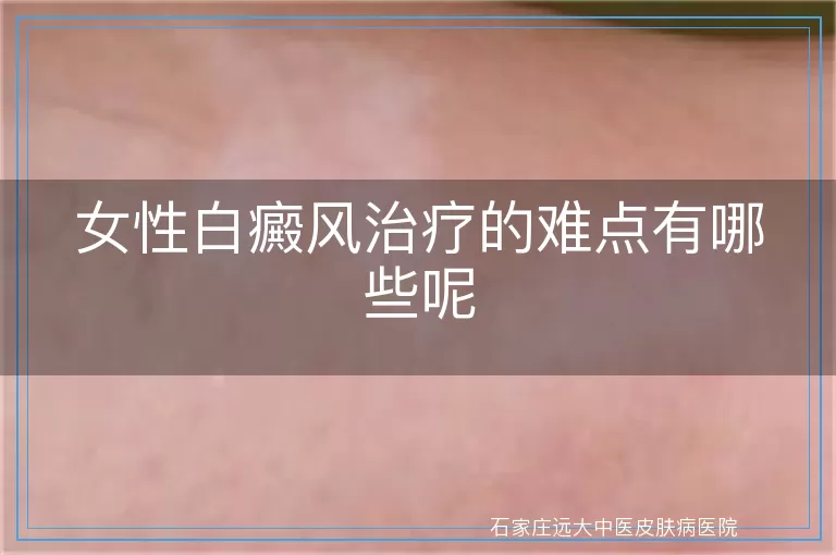 女性白癜风治疗的难点有哪些呢