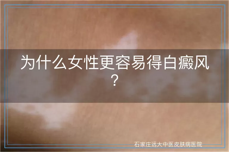 为什么女性更容易得白癜风？