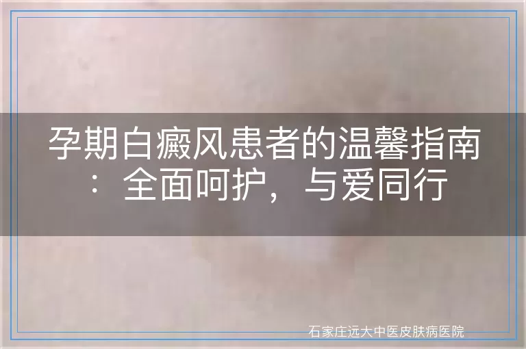 孕期白癜风患者的温馨指南：全面呵护，与爱同行