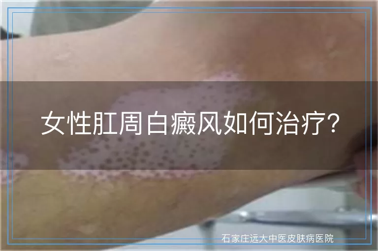 女性肛周白癜风如何治疗？