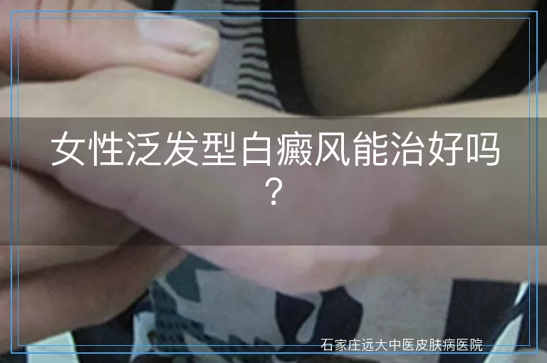 女性泛发型白癜风能治好吗？