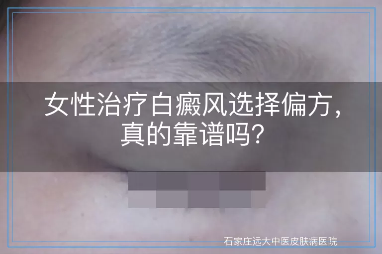 女性治疗白癜风选择偏方，真的靠谱吗？