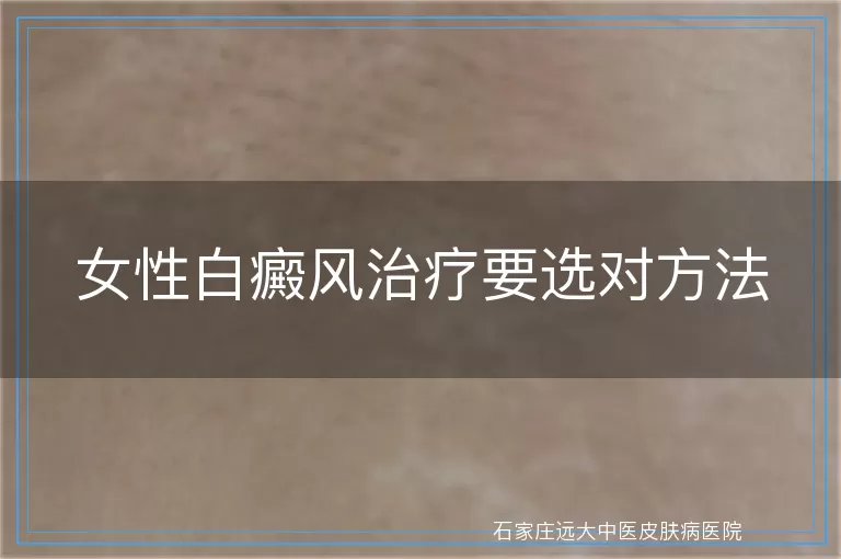 女性白癜风治疗要选对方法
