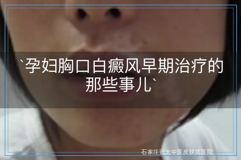 孕妇胸口白癜风早期治疗的那些事儿