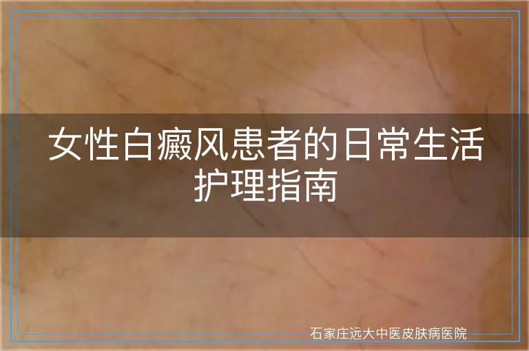 女性白癜风患者的日常生活护理指南