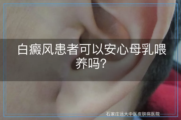 白癜风患者可以安心母乳喂养吗？