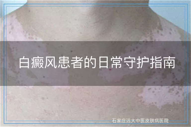 白癜风患者的日常守护指南