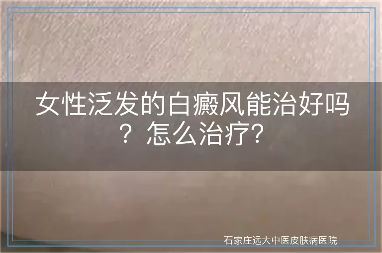 女性泛发的白癜风能治好吗？怎么治疗？