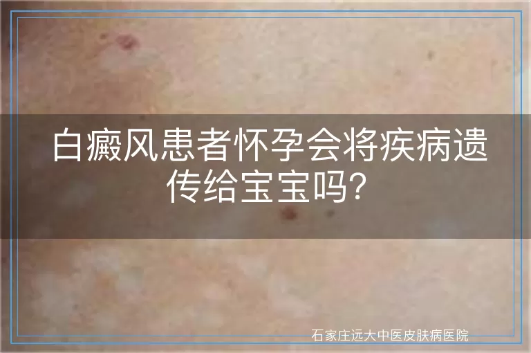 白癜风患者怀孕会将疾病遗传给宝宝吗？