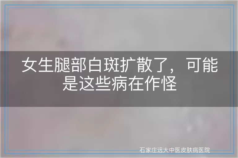 女生腿部白斑扩散了，可能是这些病在作怪
