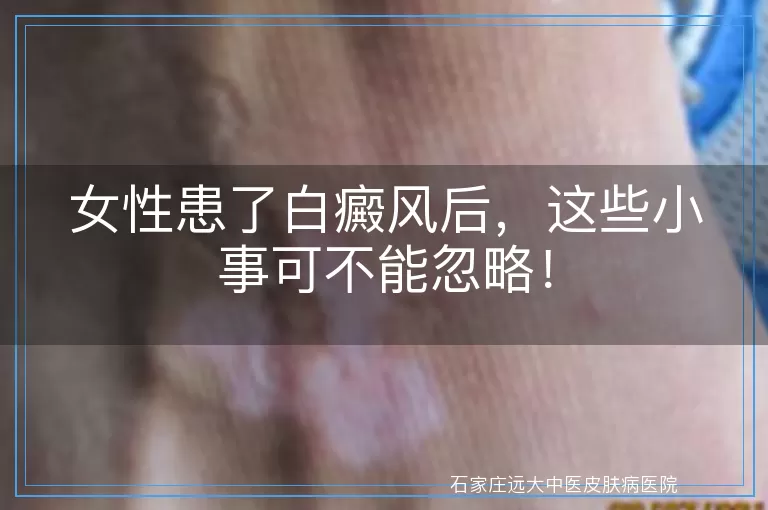 女性患了白癜风后，这些小事可不能忽略！