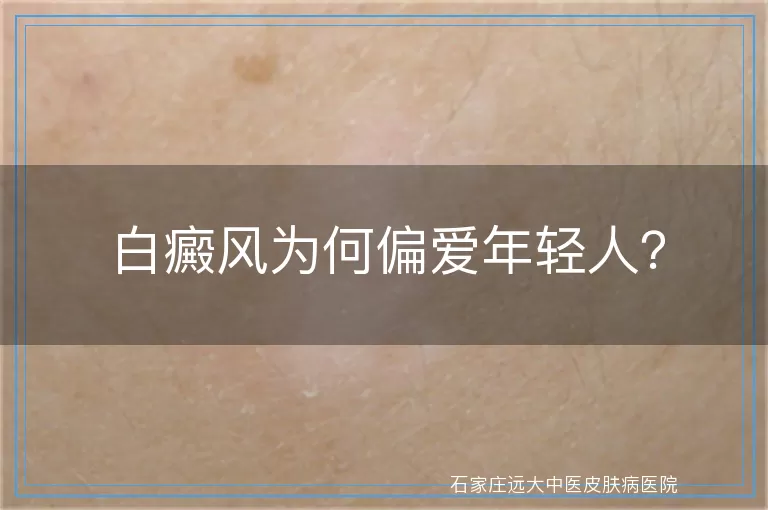 白癜风为何偏爱年轻人？