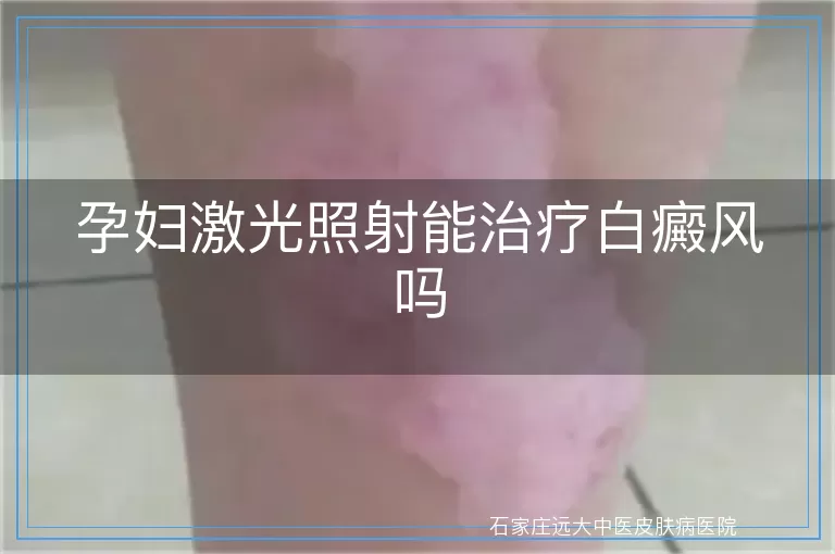 孕妇激光照射能治疗白癜风吗