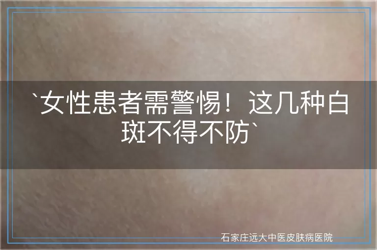 女性患者需警惕！这几种白斑不得不防