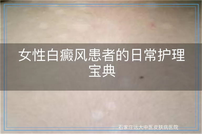 女性白癜风患者的日常护理宝典