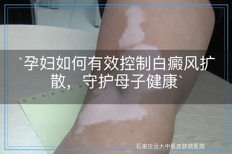 孕妇如何有效控制白癜风扩散，守护母子健康