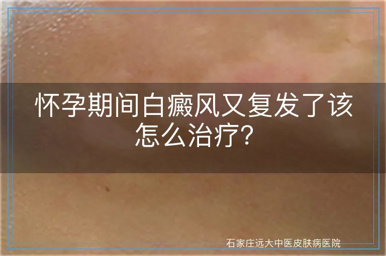 怀孕期间白癜风又复发了该怎么治疗？