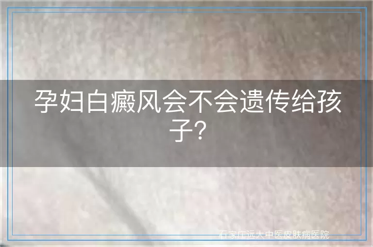 孕妇白癜风会不会遗传给孩子？