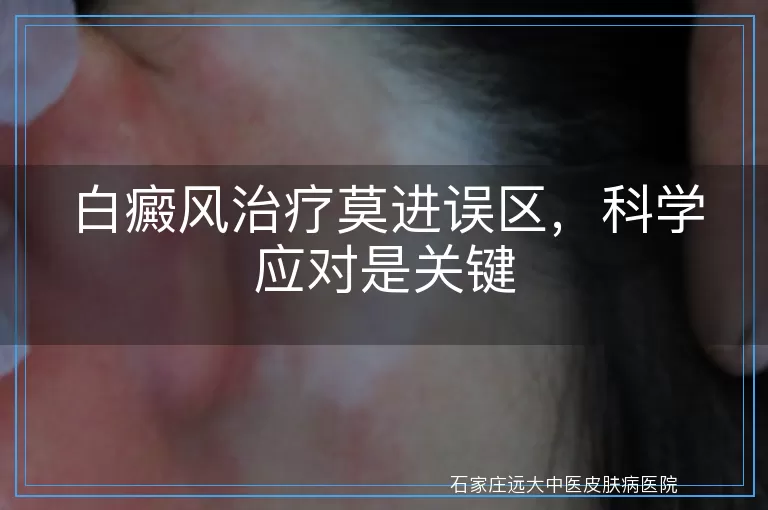 白癜风治疗莫进误区，科学应对是关键