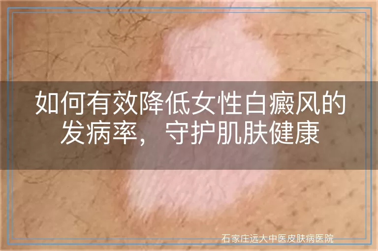 如何有效降低女性白癜风的发病率，守护肌肤健康