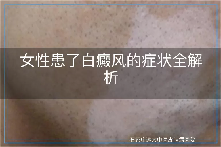 女性患了白癜风的症状全解析