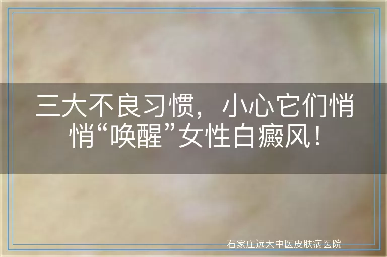三大不良习惯，小心它们悄悄“唤醒”女性白癜风！