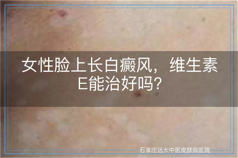 女性脸上长白癜风，维生素E能治好吗？