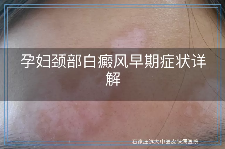 孕妇颈部白癜风早期症状详解