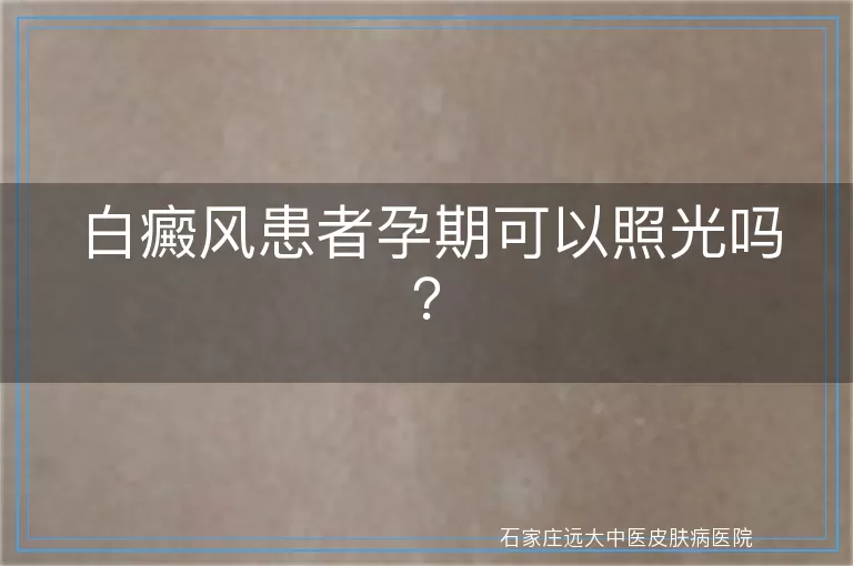 白癜风患者孕期可以照光吗？