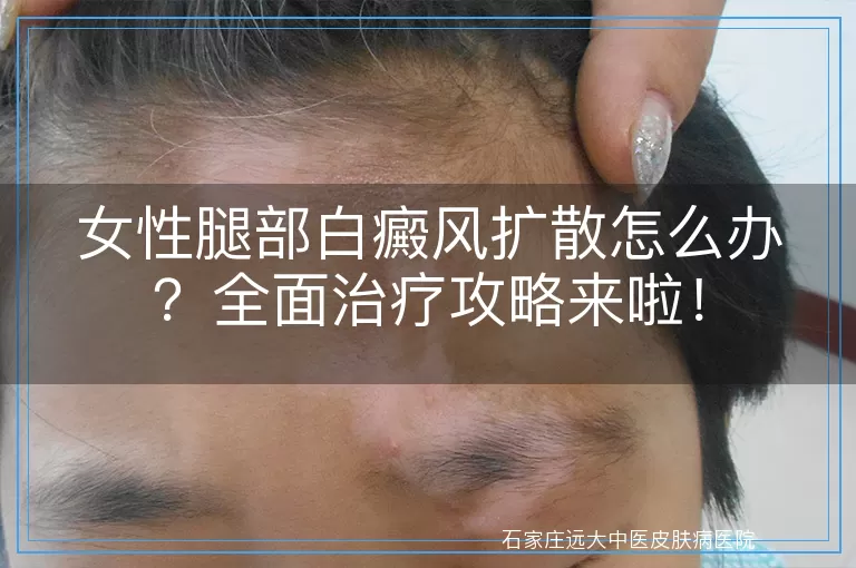 女性腿部白癜风扩散怎么办？全面治疗攻略来啦！