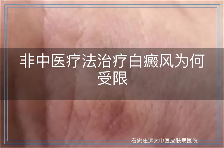 非中医疗法治疗白癜风为何受限