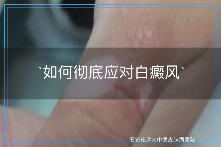 如何彻底应对白癜风